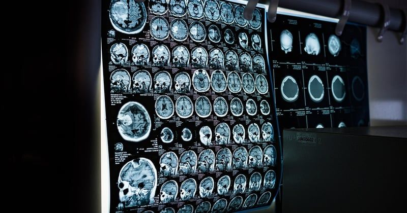 Dépistage du cancer du poumon généralisé : une avancée qui peut sauver des vies